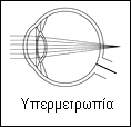 υπερμετρωπία