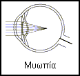 Μυωπία